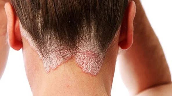 Natural Ringworm Anti-itch Ointment