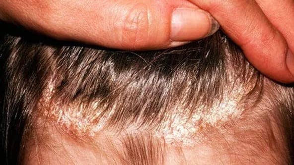 Natural Ringworm Anti-itch Ointment