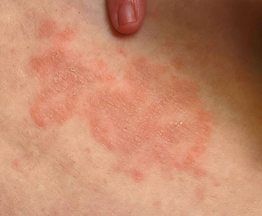 Natural Ringworm Anti-itch Ointment