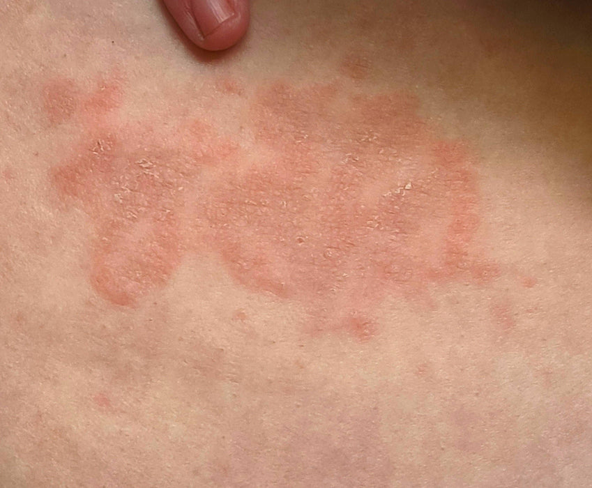 Natural Ringworm Anti-itch Ointment