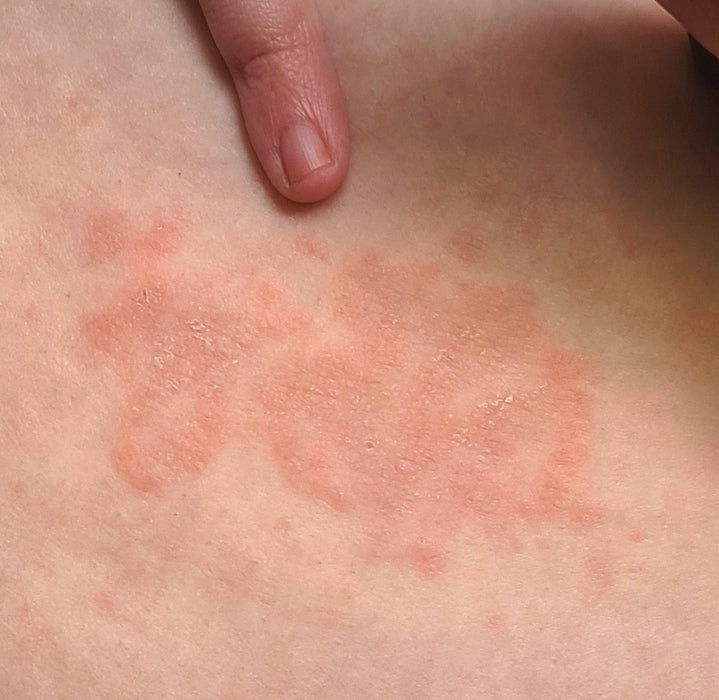Natural Ringworm Anti-itch Ointment