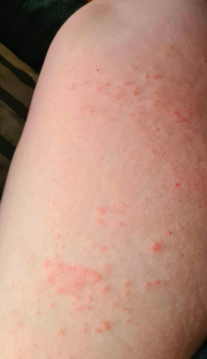 Natural Ringworm Anti-itch Ointment